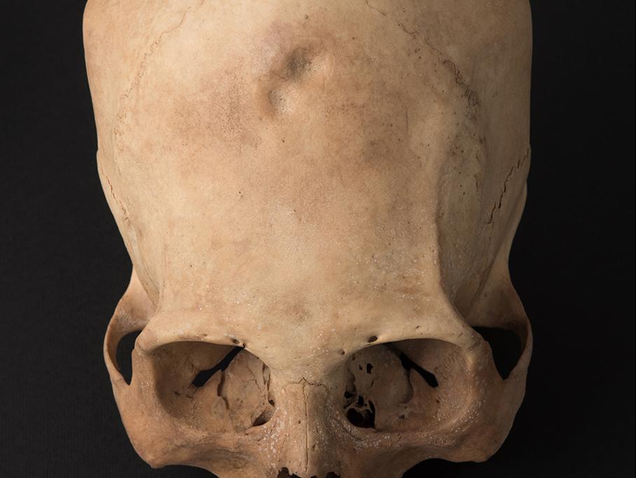 Cráneo con deformación anular erecta, sitio Az-105/Playa Miller 10 (sic)