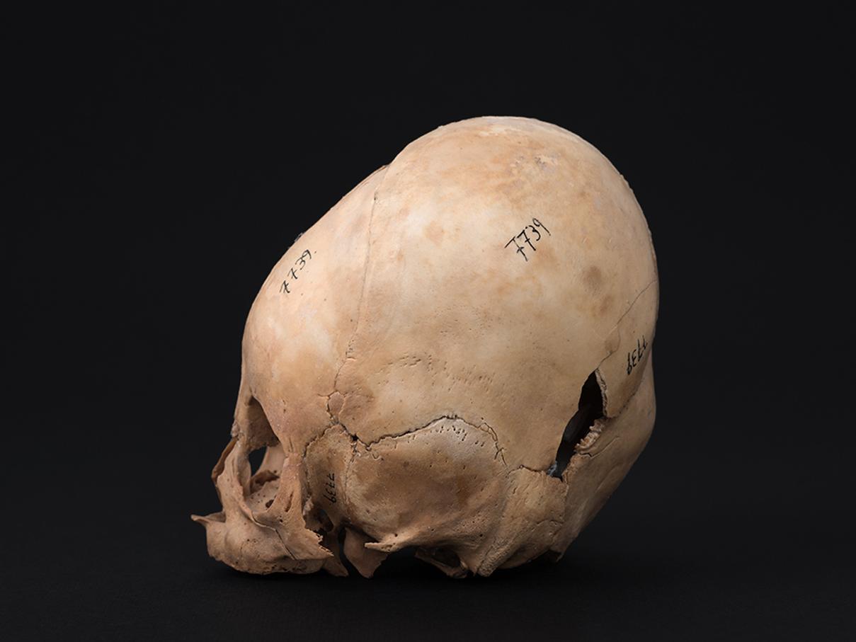 Cráneo con deformación tabular erecta, sitio Hacienda Camarones