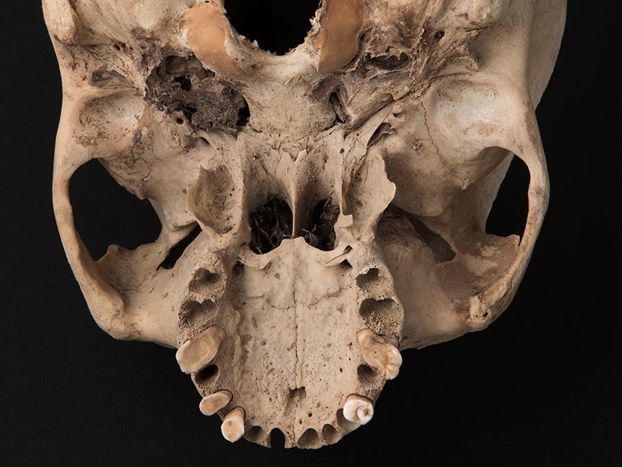 Cráneo con deformación tabular oblicua, sitio Santa Rosita