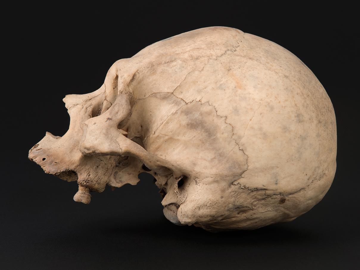 Cráneo con deformación anular oblicua, sitio Santa Rosita