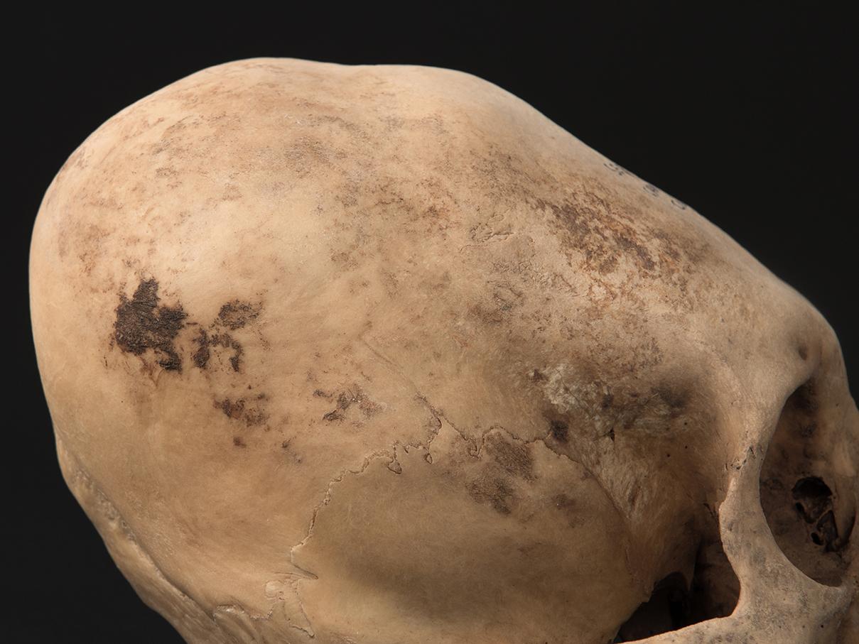 Detalle de cráneo con deformación anular oblicua, sitio Cxa E-6 (Conanoxa)
